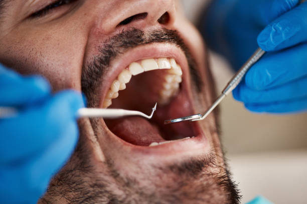 Best Emergency Tooth Extraction in Burtonsville, MD